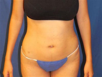 Liposuction Before & After Gallery - Patient 188698 - Image 2