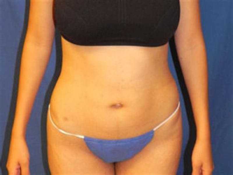 Liposuction Before & After Gallery - Patient 188698 - Image 2