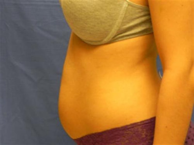Liposuction Before & After Gallery - Patient 188698 - Image 3