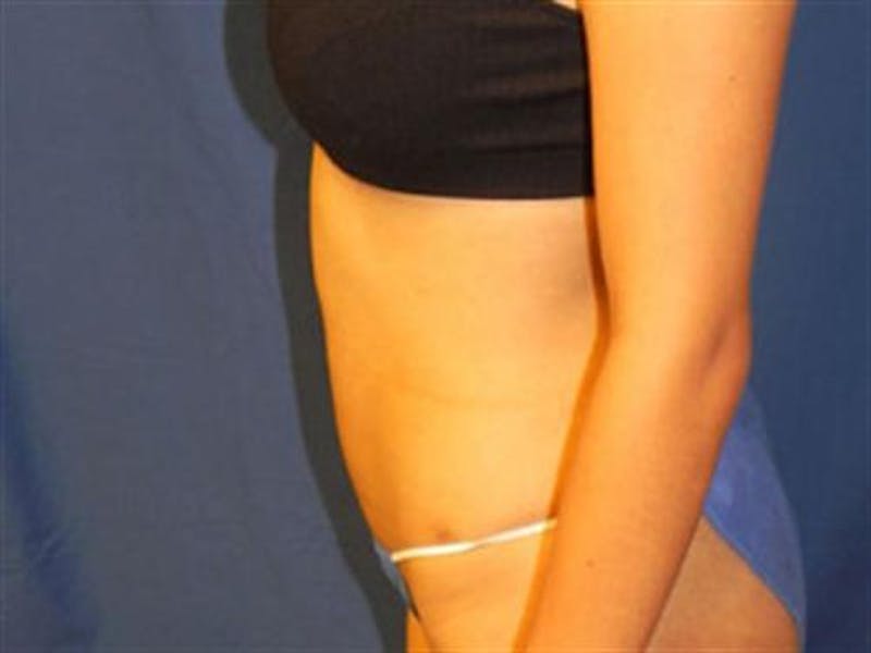 Liposuction Before & After Gallery - Patient 188698 - Image 4