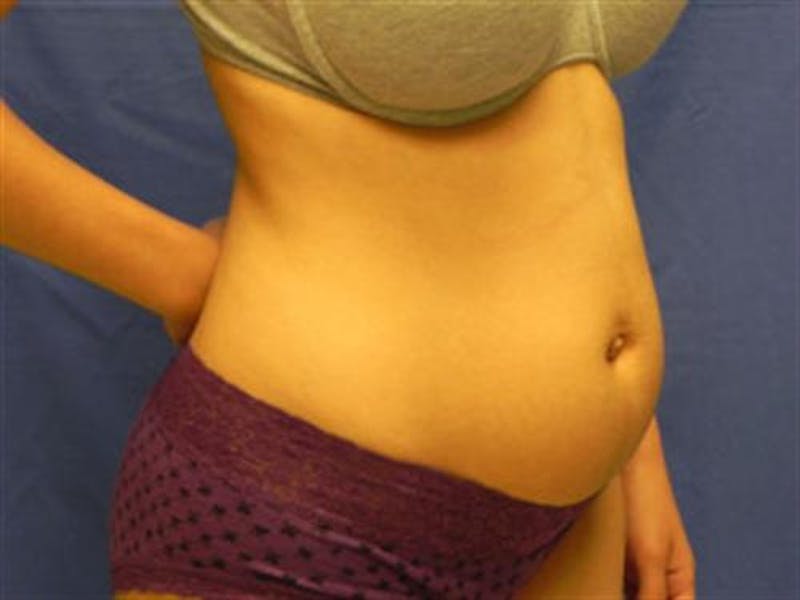 Liposuction Before & After Gallery - Patient 188698 - Image 5