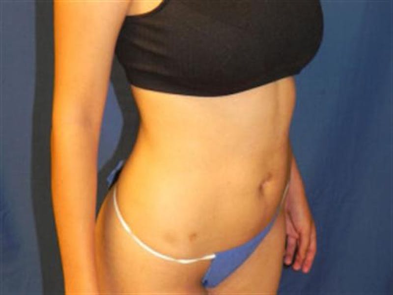 Liposuction Before & After Gallery - Patient 188698 - Image 6