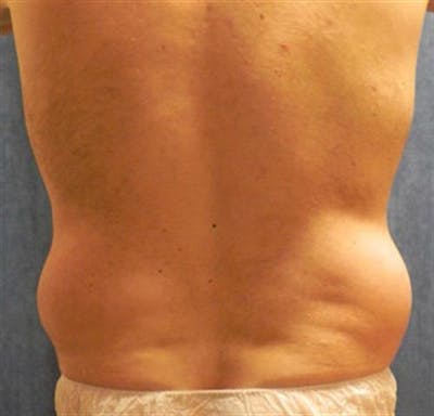 Liposuction Before & After Gallery - Patient 115946 - Image 1