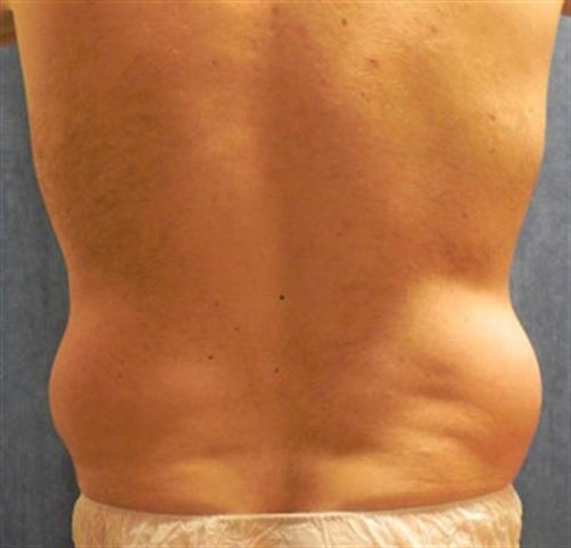 Liposuction Before & After Gallery - Patient 115946 - Image 1