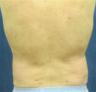 Liposuction Before & After Gallery - Patient 115946 - Image 2