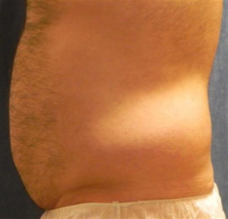Liposuction Before & After Gallery - Patient 115946 - Image 3