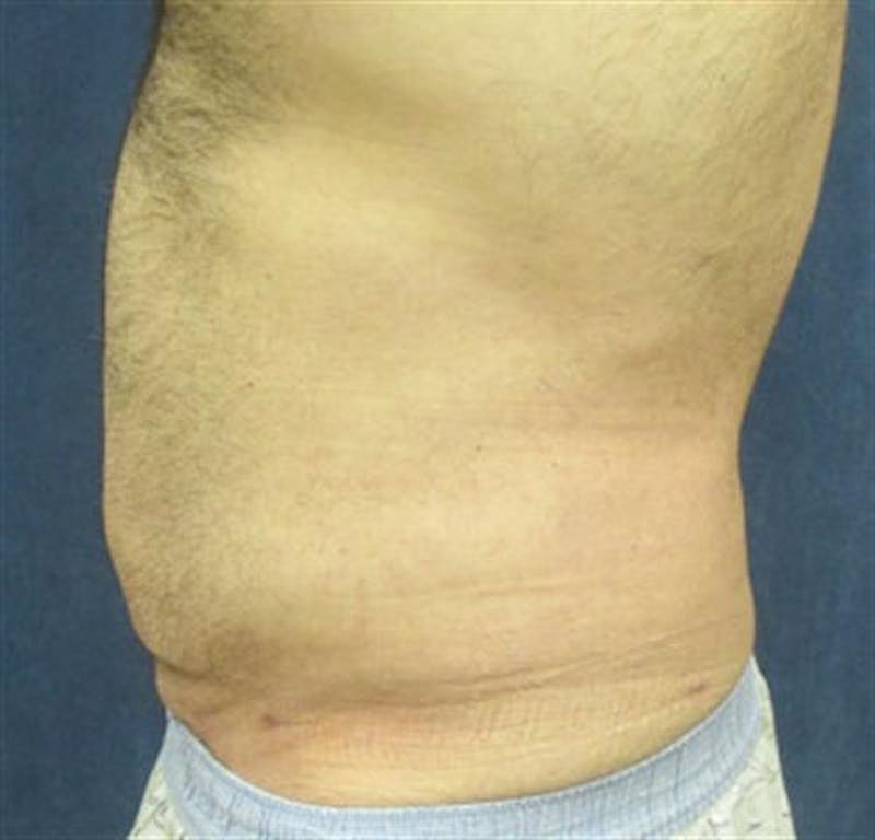 Liposuction Before & After Gallery - Patient 115946 - Image 4