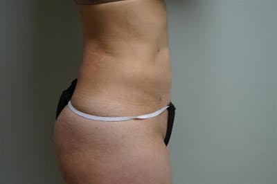 Liposuction Before & After Gallery - Patient 297265 - Image 1