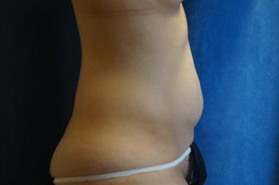 Liposuction Before & After Gallery - Patient 297265 - Image 2