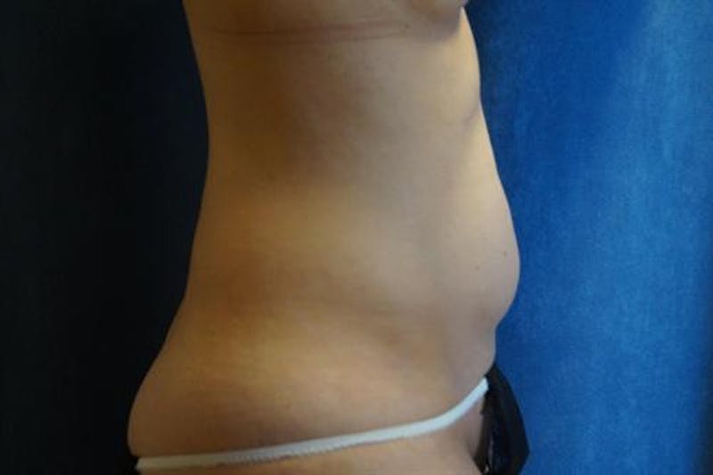 Liposuction Before & After Gallery - Patient 297265 - Image 2