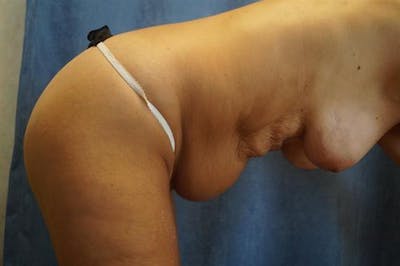 Liposuction Before & After Gallery - Patient 306049 - Image 1