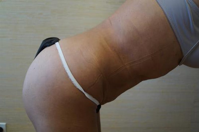 Liposuction Before & After Gallery - Patient 306049 - Image 2