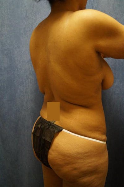 Liposuction Before & After Gallery - Patient 390271 - Image 1