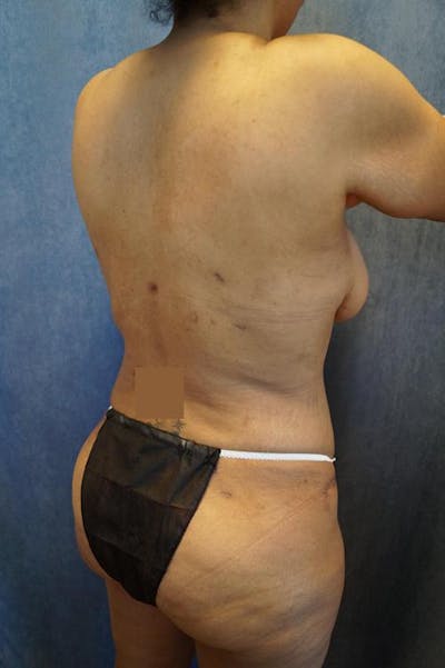 Liposuction Before & After Gallery - Patient 390271 - Image 2