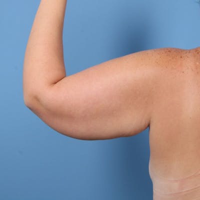Arm Lift Before & After Gallery - Patient 228065 - Image 1