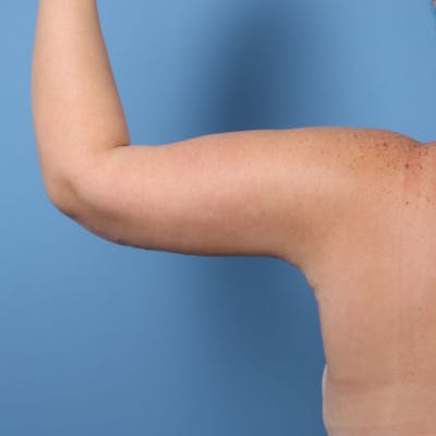 Arm Lift Before & After Gallery - Patient 228065 - Image 2