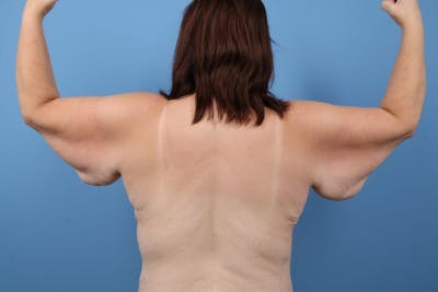 Arm Lift Before & After Gallery - Patient 113709 - Image 1