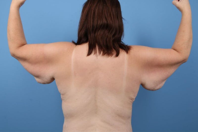 Arm Lift Before & After Gallery - Patient 113709 - Image 1