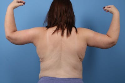 Arm Lift Before & After Gallery - Patient 113709 - Image 2
