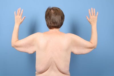 Arm Lift Before & After Gallery - Patient 208521 - Image 1