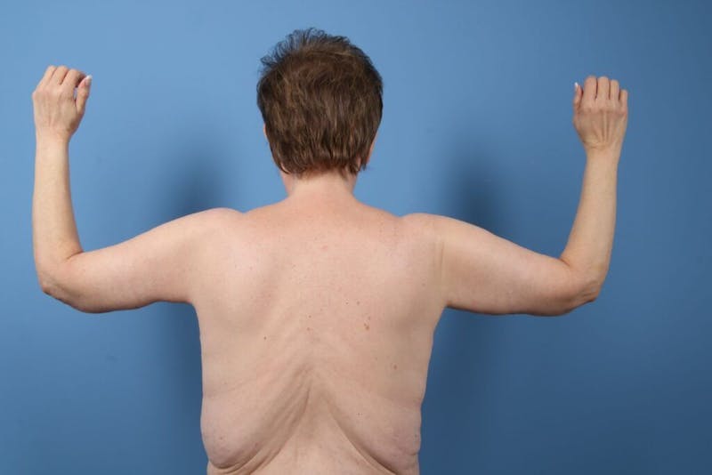 Arm Lift Before & After Gallery - Patient 208521 - Image 2