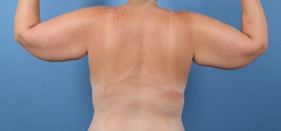 Arm Lift Before & After Gallery - Patient 205592 - Image 1