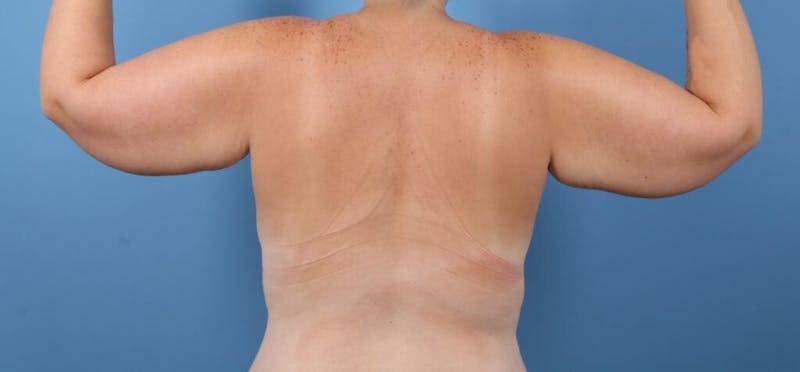 Arm Lift Before & After Gallery - Patient 205592 - Image 1