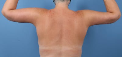 Arm Lift Before & After Gallery - Patient 205592 - Image 2