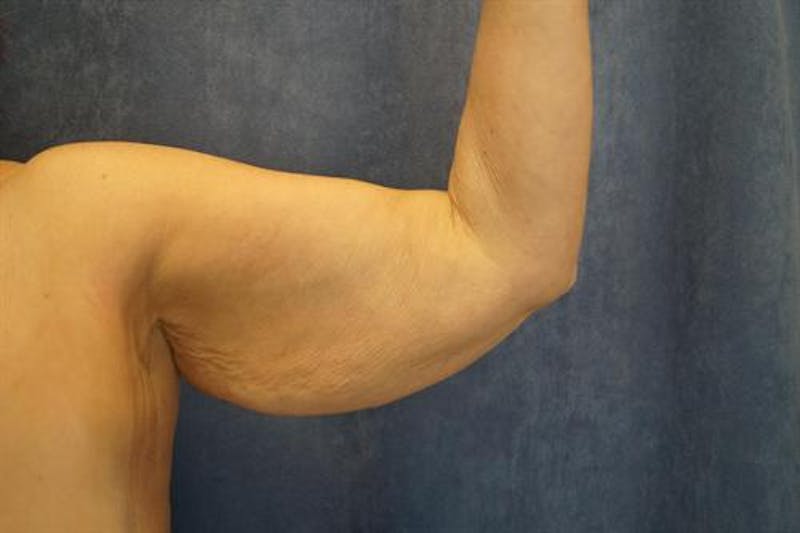 Arm Lift Before & After Gallery - Patient 232930 - Image 1