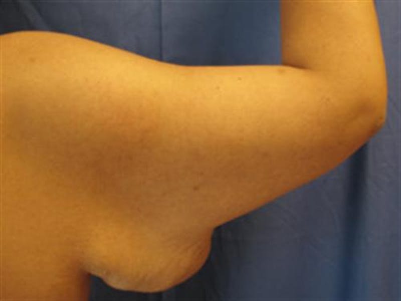 Arm Lift Before & After Gallery - Patient 255486 - Image 1