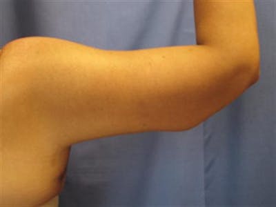 Arm Lift Before & After Gallery - Patient 255486 - Image 2