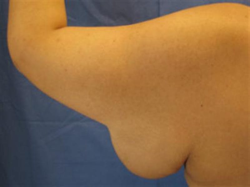 Arm Lift Before & After Gallery - Patient 255486 - Image 3