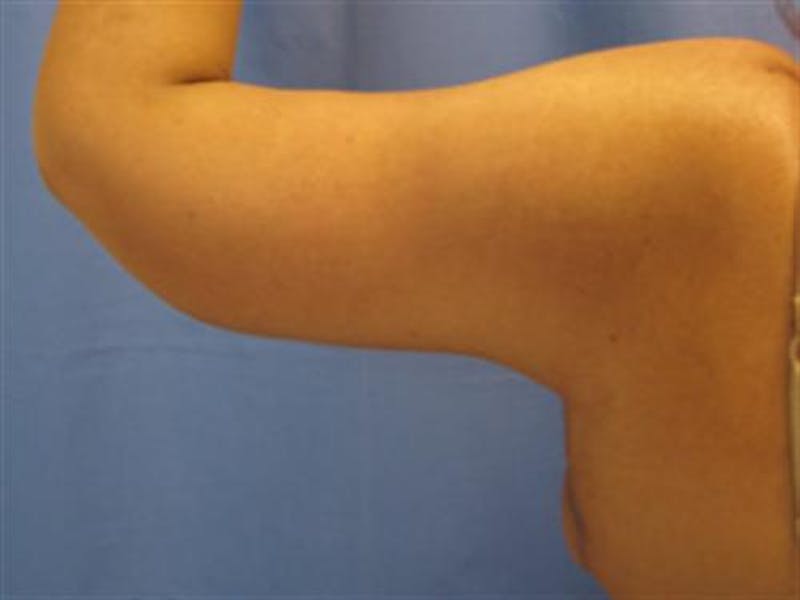 Arm Lift Before & After Gallery - Patient 255486 - Image 4