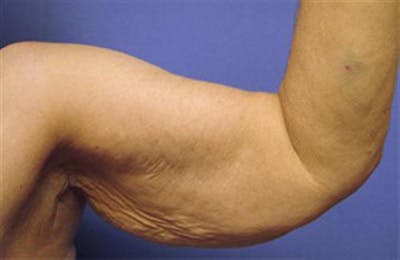 Arm Lift Before & After Gallery - Patient 384504 - Image 1