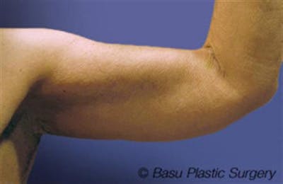 Arm Lift Before & After Gallery - Patient 384504 - Image 2