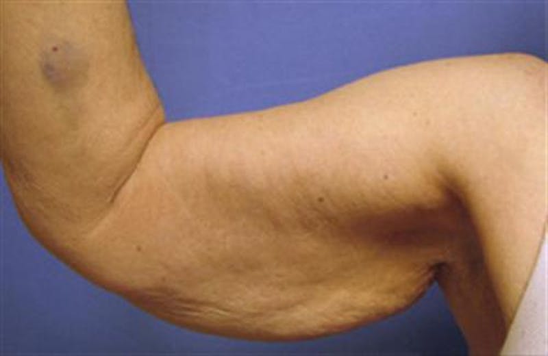 Arm Lift Before & After Gallery - Patient 384504 - Image 3