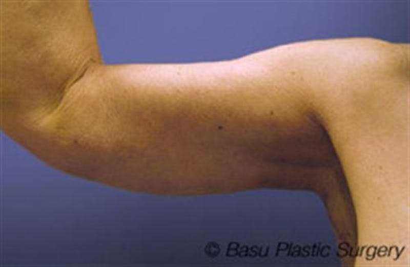 Arm Lift Before & After Gallery - Patient 384504 - Image 4