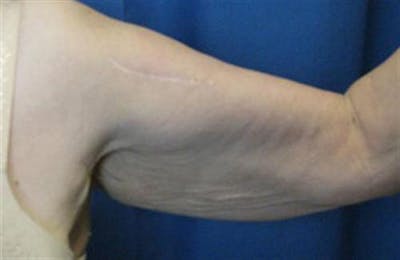 Arm Lift Before & After Gallery - Patient 265492 - Image 1