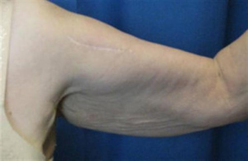 Arm Lift Before & After Gallery - Patient 265492 - Image 1