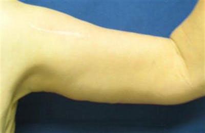 Arm Lift Before & After Gallery - Patient 265492 - Image 2