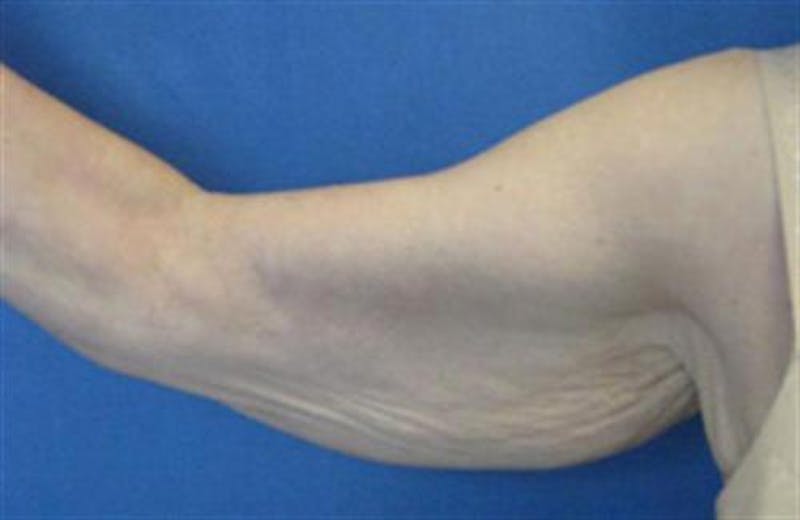 Arm Lift Before & After Gallery - Patient 265492 - Image 3