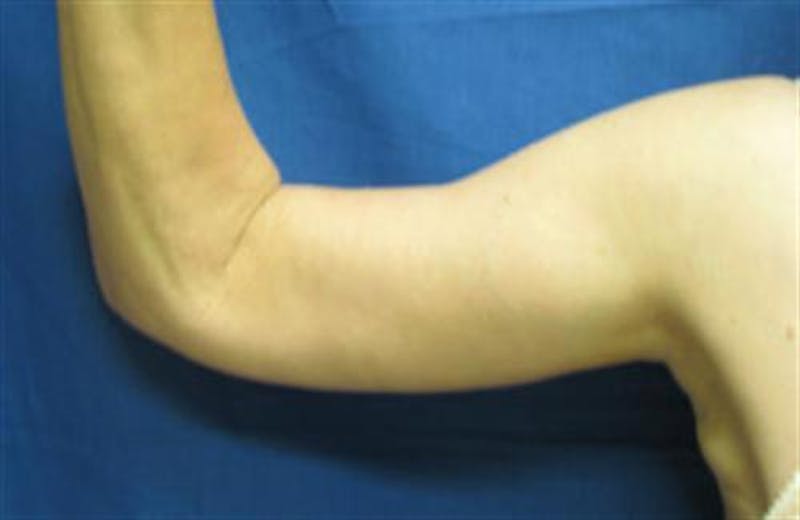 Arm Lift Before & After Gallery - Patient 265492 - Image 4