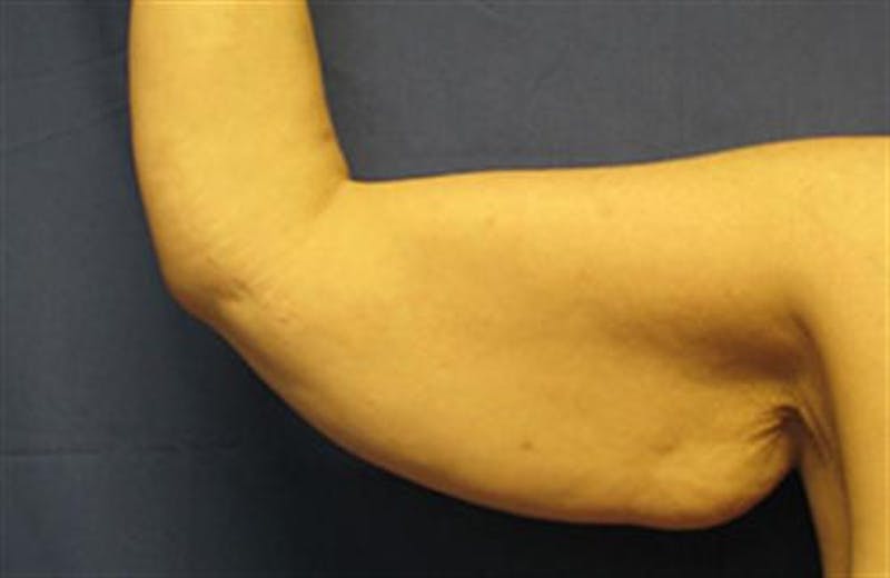 Arm Lift Before & After Gallery - Patient 131884 - Image 1