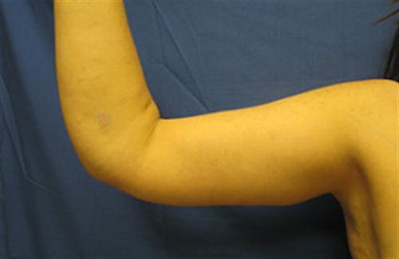 Arm Lift Before & After Gallery - Patient 131884 - Image 2