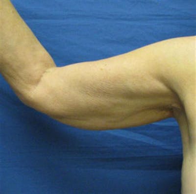 Arm Lift Before & After Gallery - Patient 468508 - Image 1