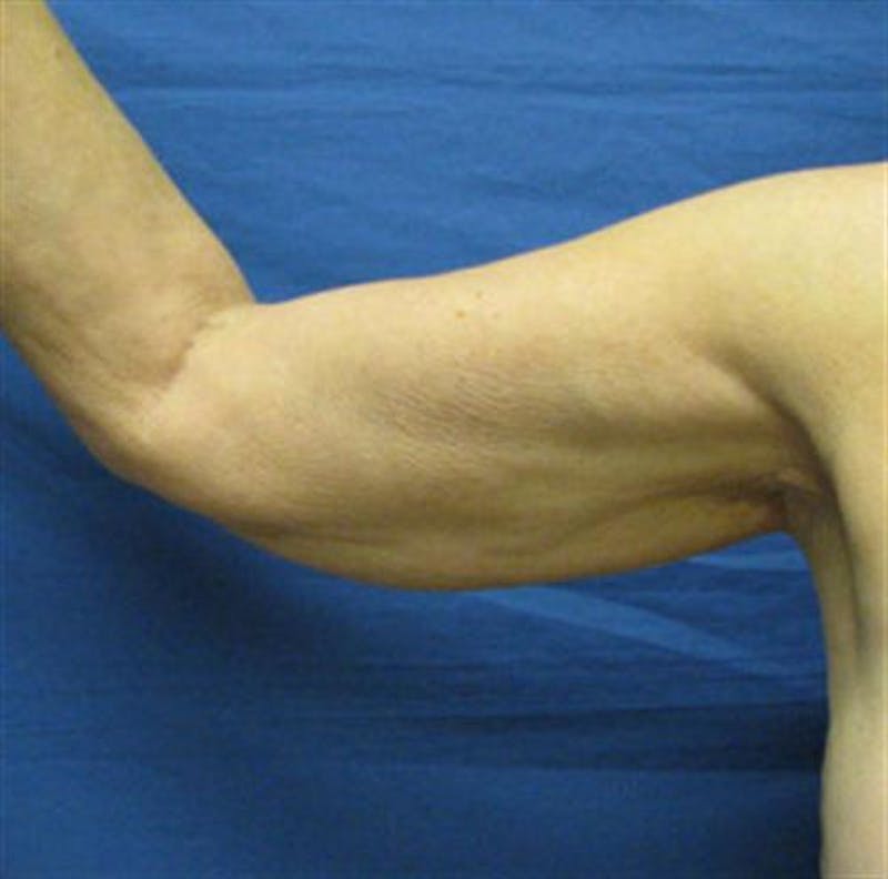 Arm Lift Before & After Gallery - Patient 468508 - Image 1