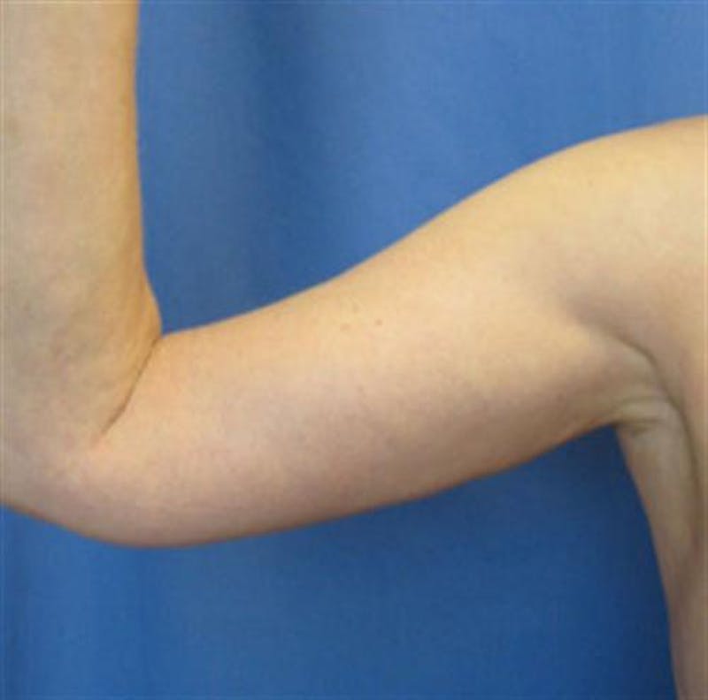 Arm Lift Before & After Gallery - Patient 468508 - Image 2