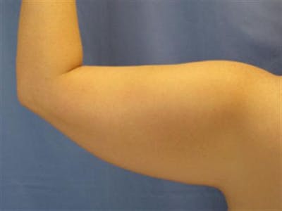 Arm Lift Before & After Gallery - Patient 174781 - Image 1
