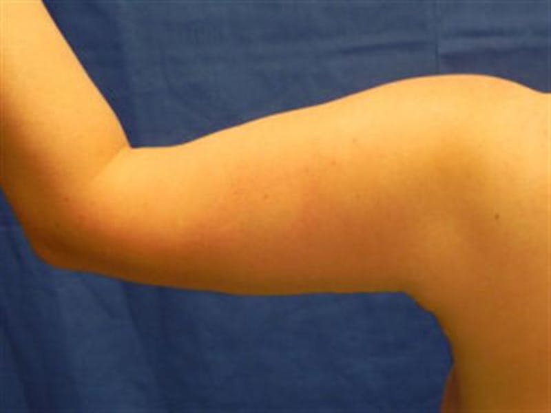Arm Lift Before & After Gallery - Patient 174781 - Image 2