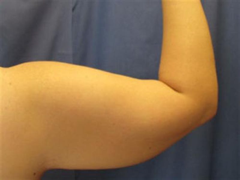 Arm Lift Before & After Gallery - Patient 174781 - Image 3
